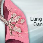 Lung cancer and bronchogenic carcinoma slides for HA CMA and paramedic staffs nepal license and loksewa