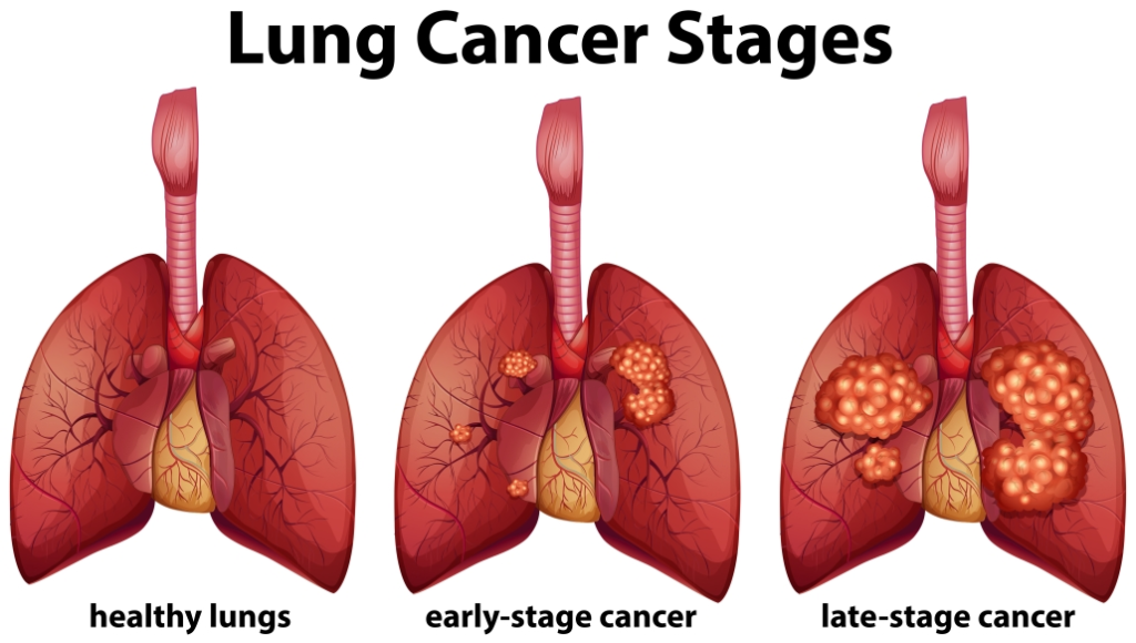 lung cancer and its staging