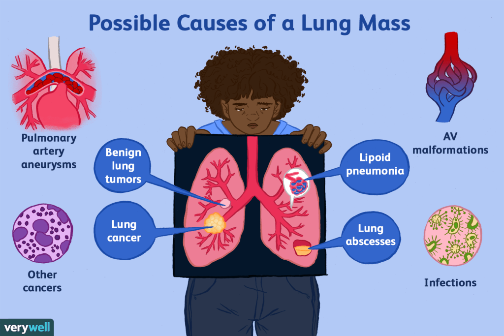 Possible other causes of lung mass