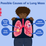 Top 6 Treatment Options for Lung cancer in Modern Medicine is Currently Using (and everything about lung cancer)