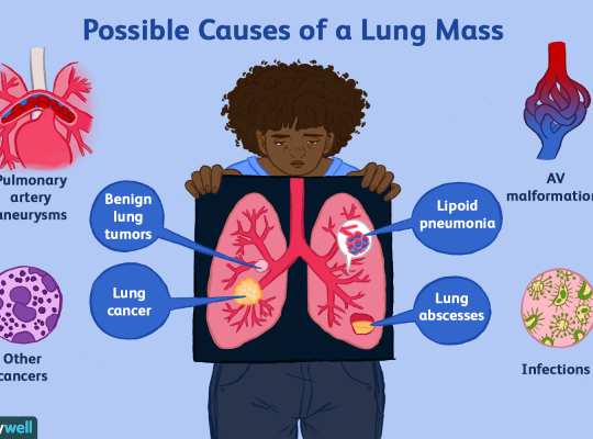 Lung cancer