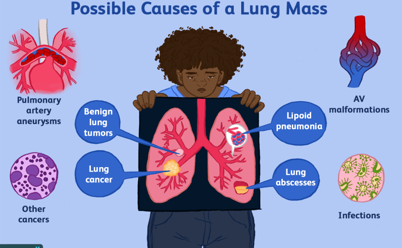 Lung cancer