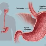 Gastritis for medical students: GERD, gastritis, esophagitis, duodenitis, gastroduodenitis, Pepric ulcer disease and more