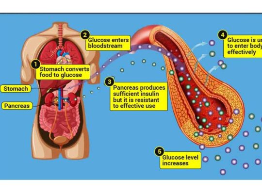 diabetes mellitus