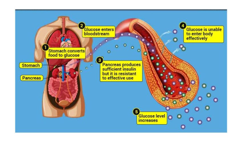 diabetes mellitus