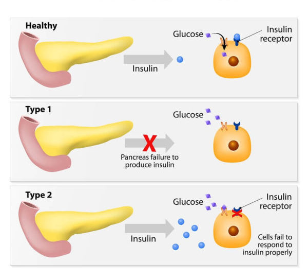 type 1 vs type 2 diabetes