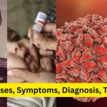 Understanding Polio: Causes, Symptoms, Prevention, and Treatment