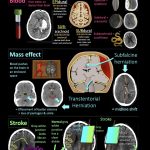 How to read a CT scan of head?