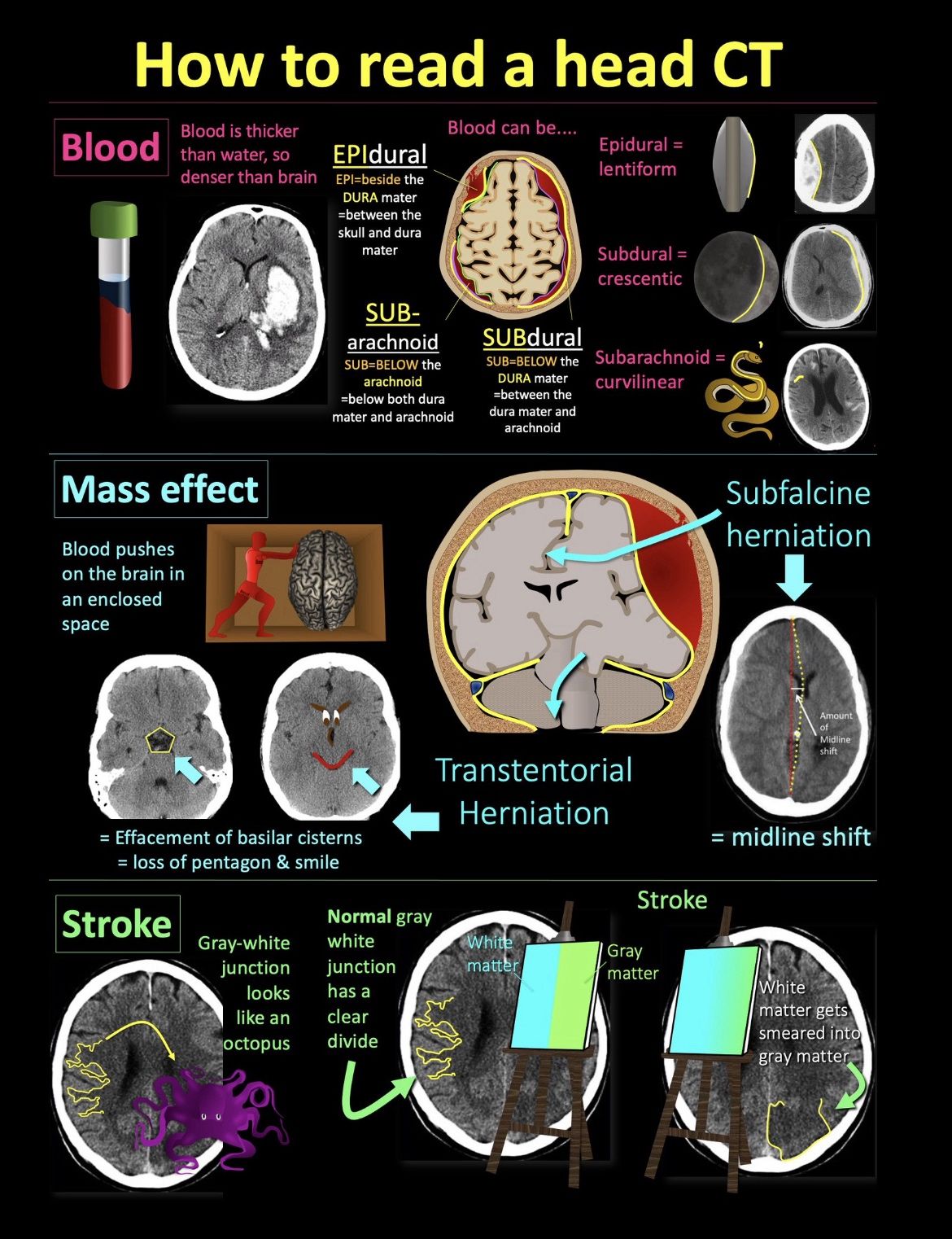 How To Read A CT Scan Of Head Dr Chaitanya Joshi MD