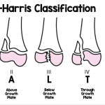 Salter Harris Classification : The Must Know Topic in Orthopedics
