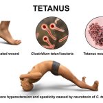 What is opisthotonus?