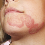 TINEA FACIEI: Bad-looking itch on your face Diagnosis!