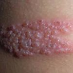 Postherpetic neuralgia (PHN) – Jaipur Block for Postherpetic neuralgia (PHN)