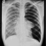 Pneumothorax and pleural effusion by dr chaitanya with pathophysiology of pleural effusion 2024