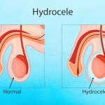 Hemorroids and hydrocele: treatment and complications ppt 2024
