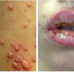 Mycoplasma pneumonia : The dangerous walking talking pneumonia