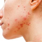 7 tips on How to Get Rid of Acne Scars Without Surgery or Toxic Chemicals?