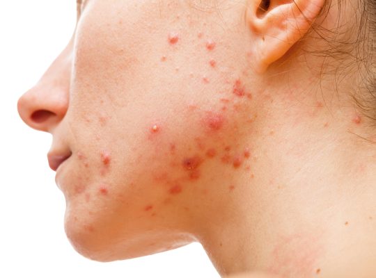 acne in cheek and jawlaine free image license less
