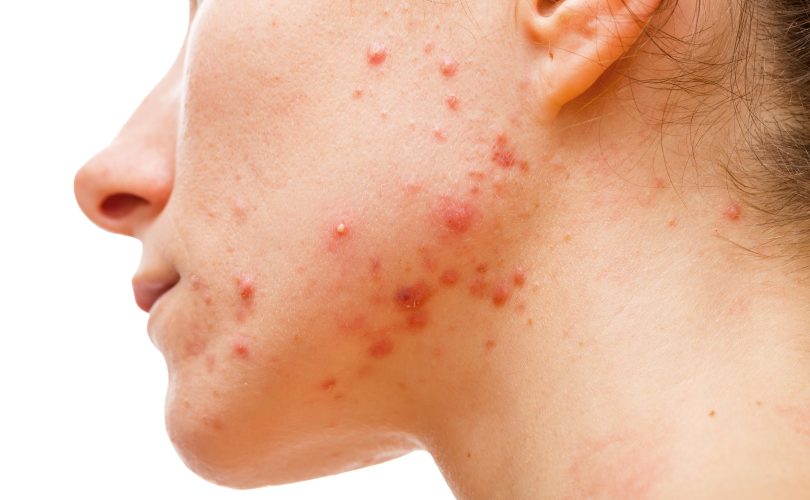 acne in cheek and jawlaine free image license less