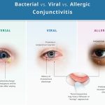 Red eye cause and treatment in Nepali- Eye Flu: रातो आखाँ हुने कारण र उपचार नेपालीमा २०२५