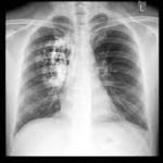 How to read chest X ray a systematic approach guide for everyone 2025