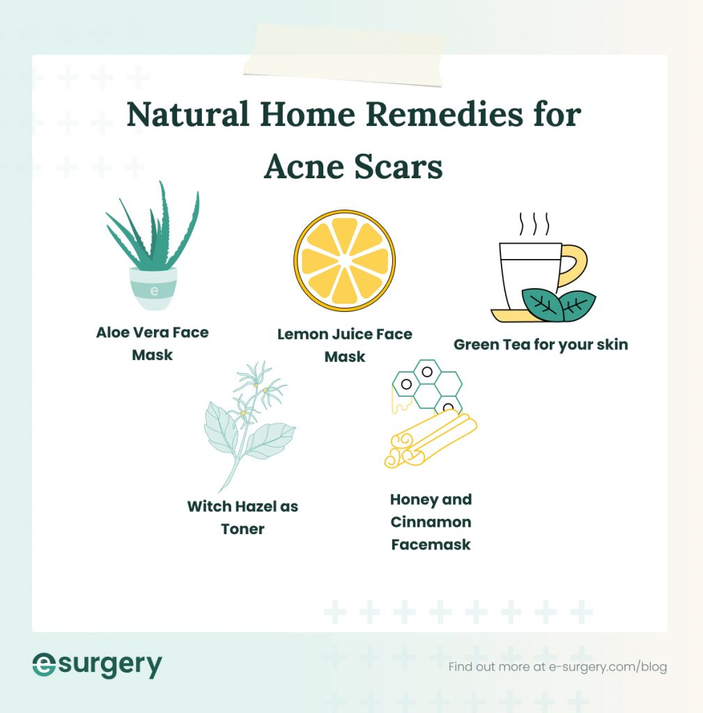 natural home remedies and treatment for acne