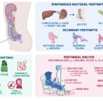 Peritonitis and bowel obstruction Lecture Presentation :causes, symptoms and treatment NHPC NNC