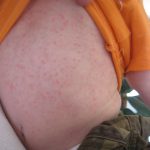 Why is There a Measles Outbreak in Texas in 2025?