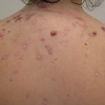 Acne: Basics to know and treatment in Nepali: के हो र कसरि उपचार गर्ने? के एक्ने उपचार सम्भव छ?