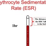 ESR and CRP: The acute phase reactants normal values and ESR Vs CRP