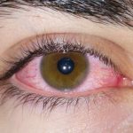 Congenital Glaucoma MCQs