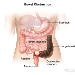 MCQs based on hernias