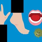 Dadura khop(दादुरा खोप)- dadura cases kathmandu 2081 short note on measles