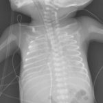 RDS and etiology and pathogenesis and treatment of hyaline membrane disease