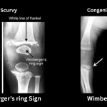 Wimberger’s Sign vs Wimberger Ring Sign A comparison