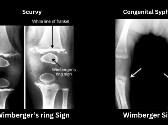 Wimberger’s Sign vs Wimberger Ring Sign A comparison