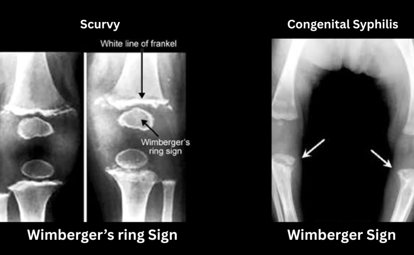Wimberger’s Sign vs Wimberger Ring Sign A comparison