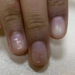 Why do I have white lines in my nail? are they dangerous?