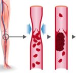 Deep Vein Thrombosis (DVT)