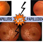 Differences : Papillitis and Papilledema