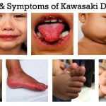 Kawasaki disease Mnemonics
