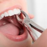 Contraindications of Tooth Extraction