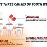 attrition vs abrasion vs erosion