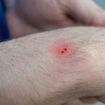 सर्पले टोकेको खण्डमा के गर्ने? सर्पदंस प्राथमिक उपचार ? Snakebite Treatment in Nepali 2026