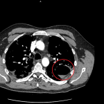 What forms Pneumoatocoeles in Pneumonia? (My doctor said there is air bubble in my lungs)