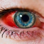 I was so scared I would GO BLIND but my doctor said THIS!