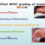 Trachoma – Key Points