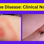 Erythema Migrans: The 3 Early Sign of Lyme Disease!