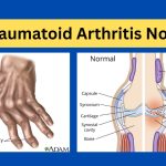 Notes on Rheumatoid Arthritis for Medical Students in Short