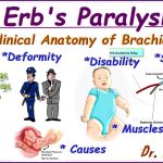 Erb’s Palsy vs Klumpke’s Paralysis